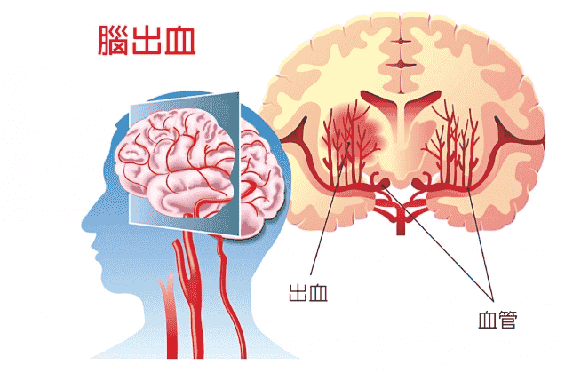 出血性腦中風