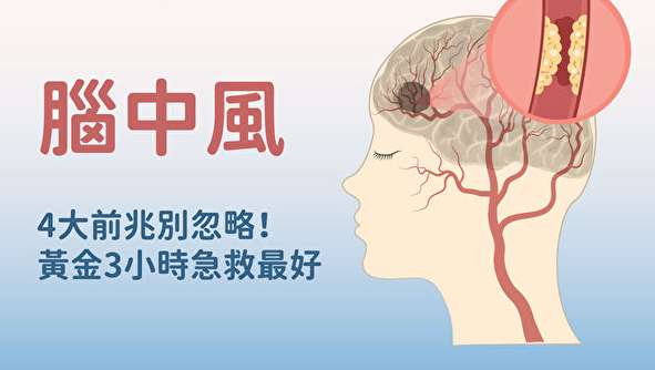 腦中風治療