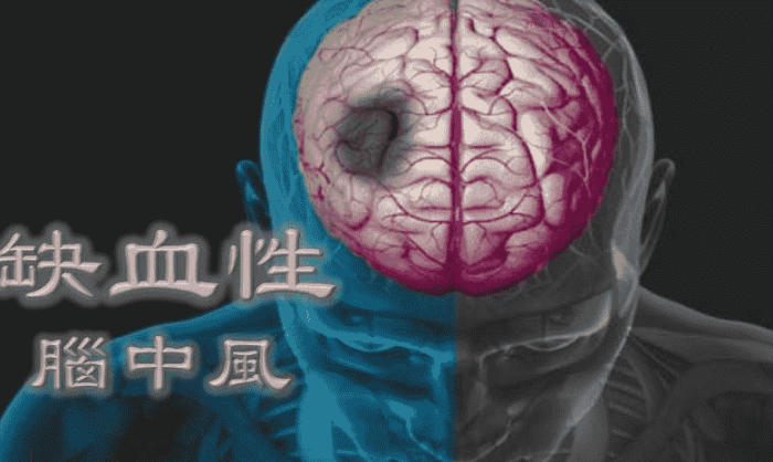 缺血性腦中風