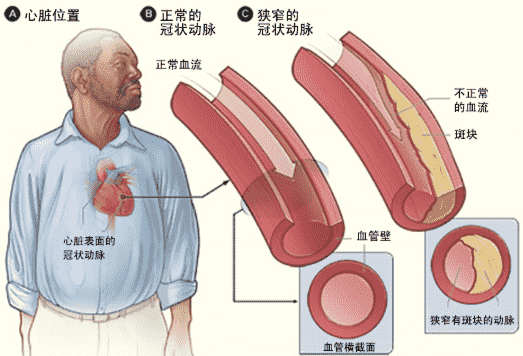 冠心病日常生活管理