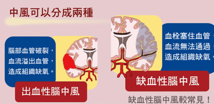 急性腦中風原因