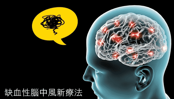 缺血性腦中風症状
