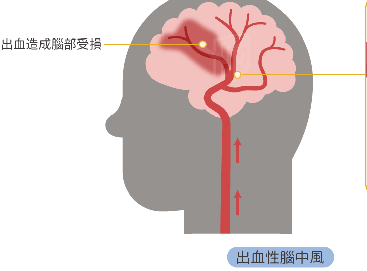 出血性腦中風症狀