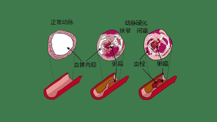 高血壓病因病機